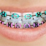 AlignBeauty-metal-braces