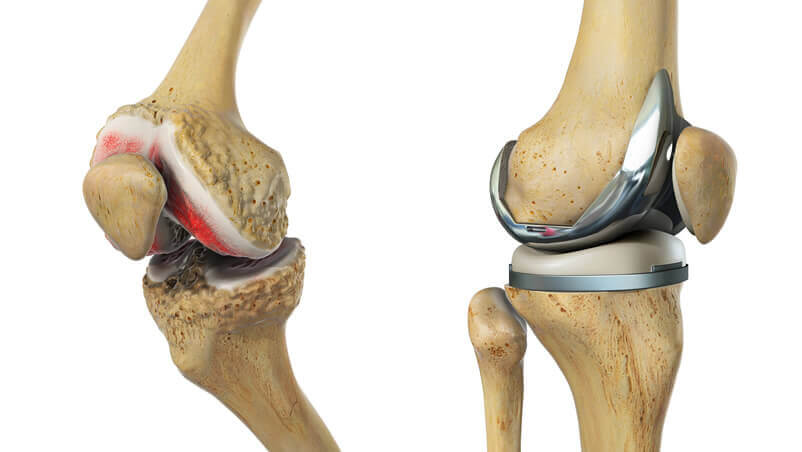 Top surgeons for knee replacement in Gurgaon